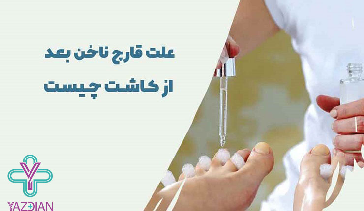 قارچ ناخن کاشت شده قارچ ناخن کاشت شده